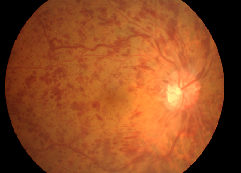 網膜中心静脈閉塞症