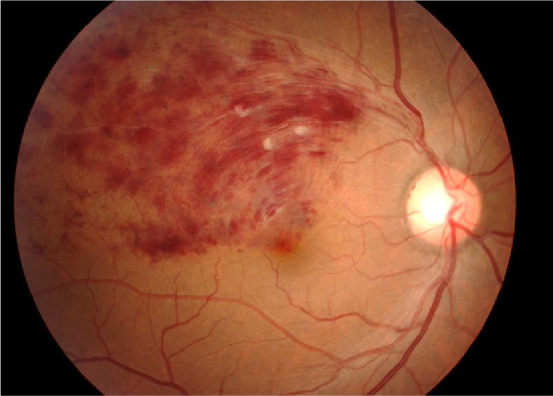 網膜静脈分枝閉塞症