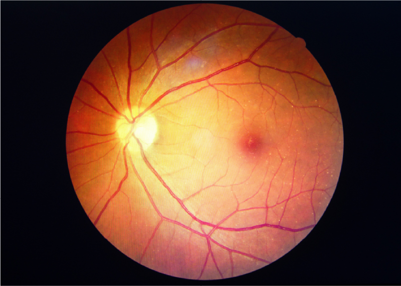 糖尿病網膜症の眼底