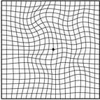 加齢黄斑変性症 歪んで見える