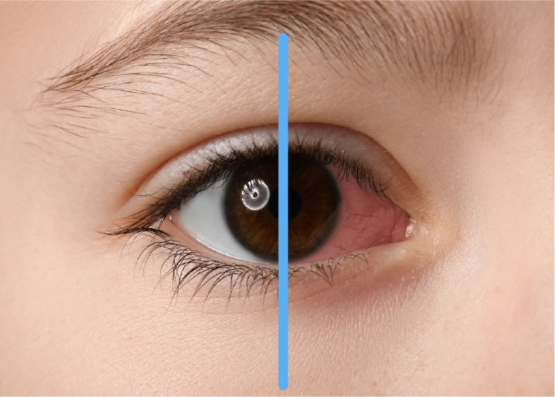 結膜炎 小児眼科